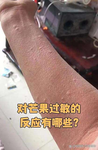 孩子吃芒果过敏是怎么回事缩略图