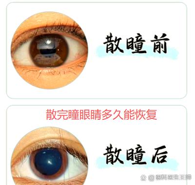 散完瞳眼睛多久能恢复缩略图