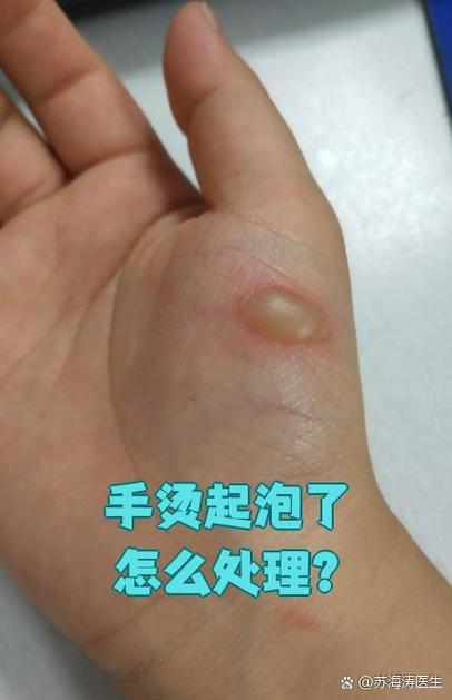 手烫起泡了破了怎么处理好得快缩略图