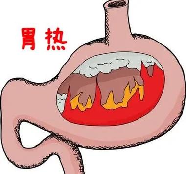 胃火旺吃什么药效果最好缩略图