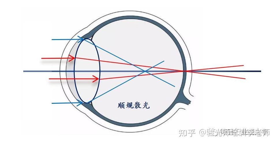 眼睛散光是怎么形成的