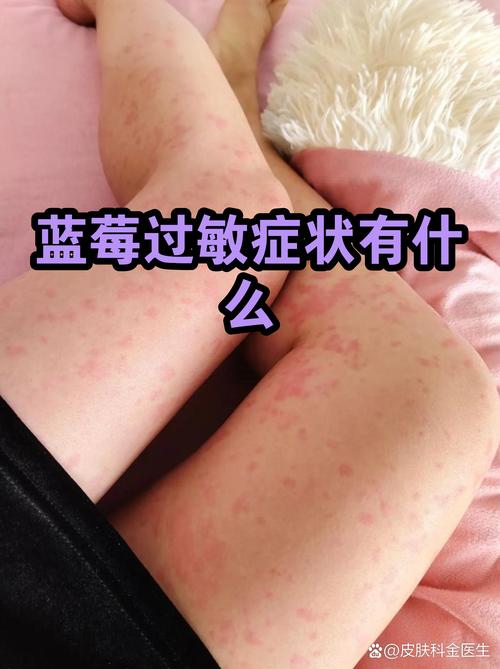 小孩蓝莓过敏症状图片缩略图