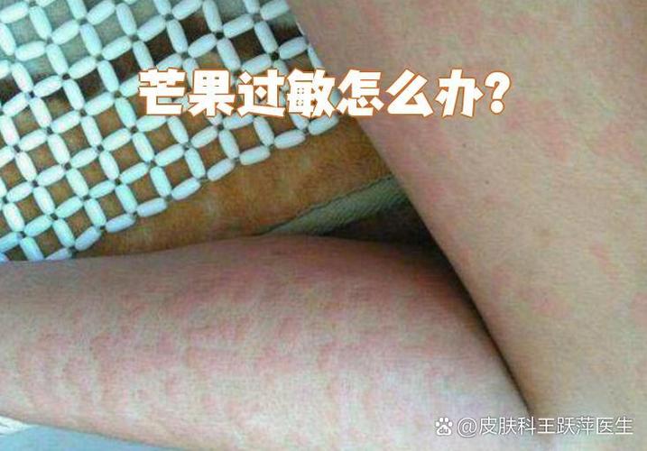 吃芒果皮肤过敏怎么办缩略图