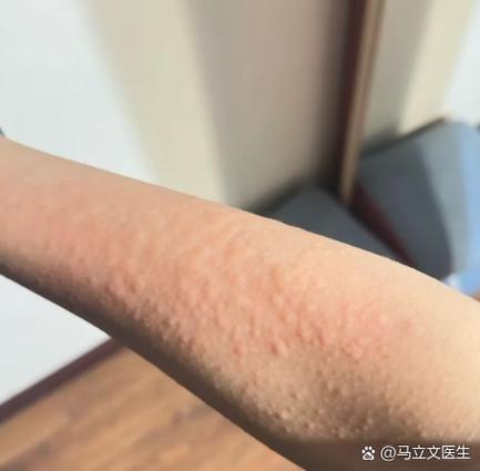 扑尔敏和香蕉敷脸对过敏有效吗?缩略图