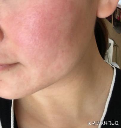 脸部过敏红痒小偏方缩略图