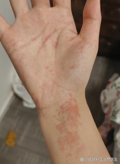 脸过敏可以吃鸡蛋吗缩略图