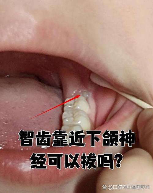 智齿在哪个位置图片缩略图