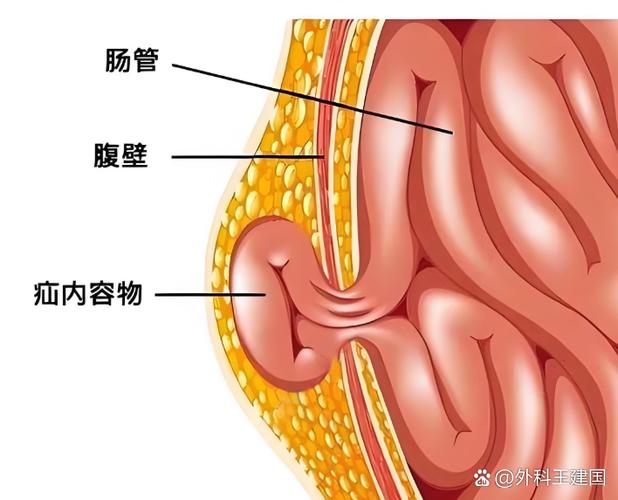 人的疝气在哪个部位