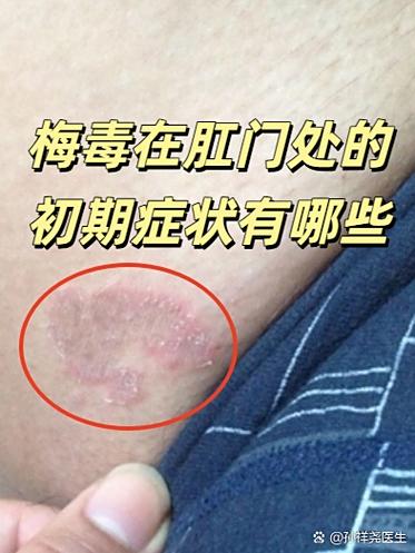 梅毒咨询医生免费咨询缩略图