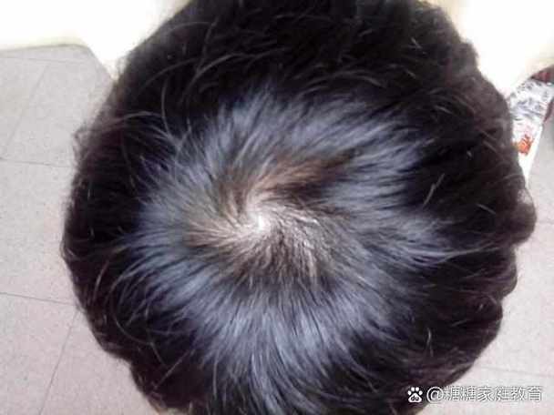 头旋形成的原因缩略图