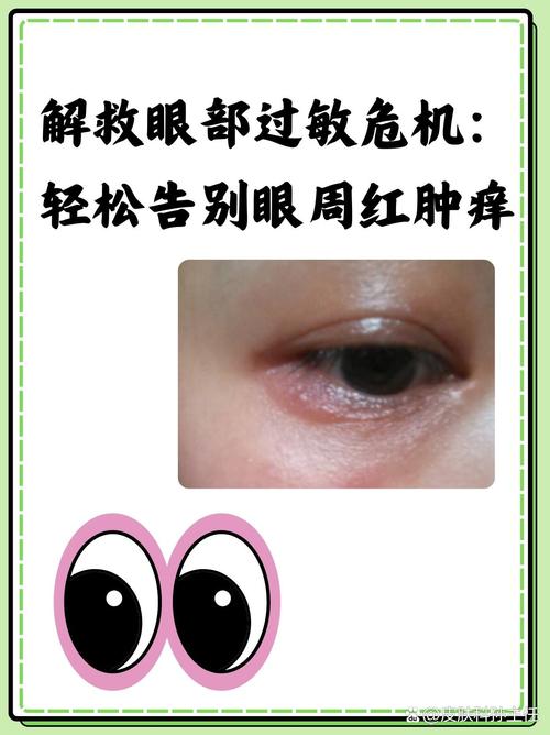 眼睛一圈红肿,痒,发红怎么办缩略图
