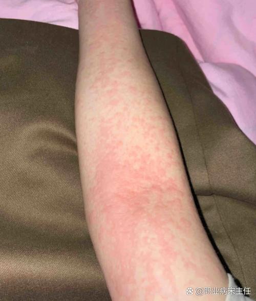 膏药贴了皮肤过敏红痒怎么办缩略图