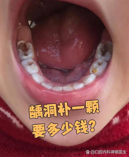 牙烂个洞补一补多少钱缩略图
