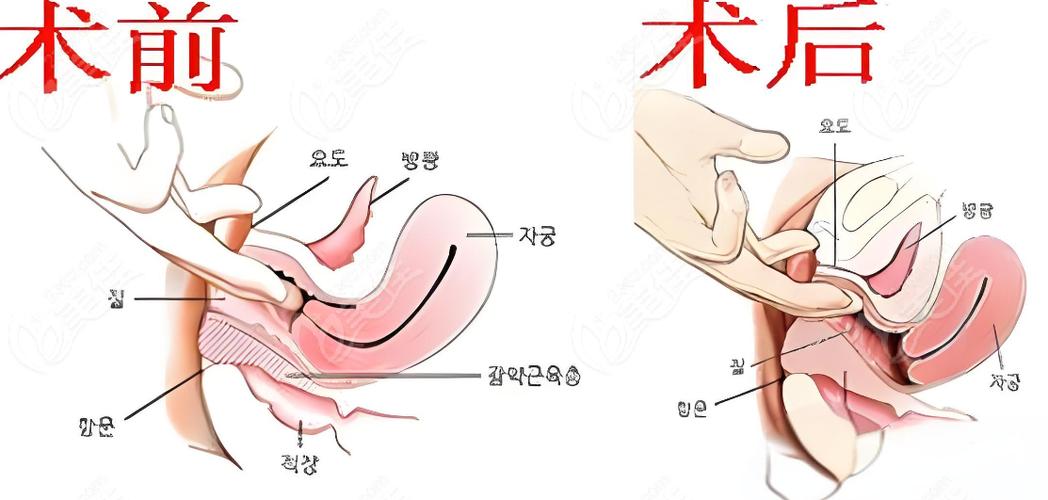 妇科紧缩手术值得做吗缩略图