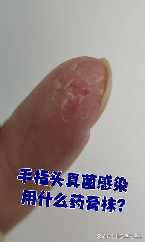 治真菌什么药效果最好缩略图
