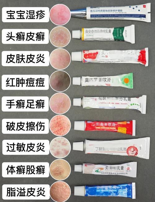 湿疹软膏哪个效果最好缩略图
