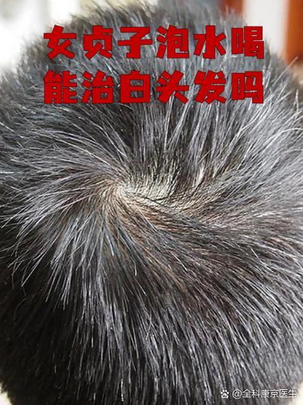 治白头发吃什么药最好最有效缩略图