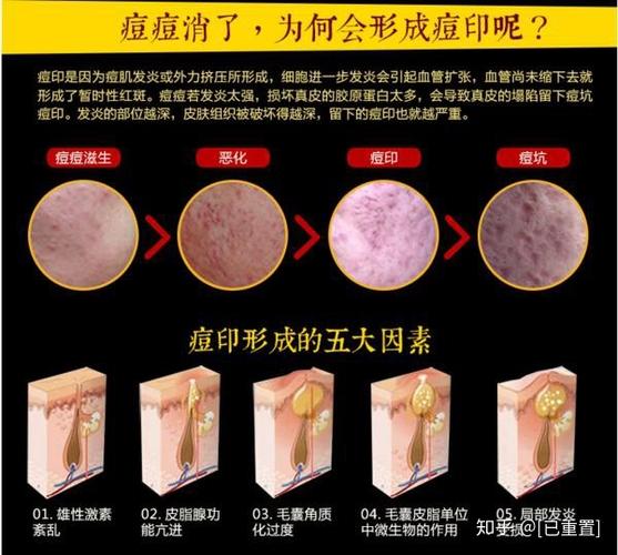 痘印痘坑可以修复吗缩略图