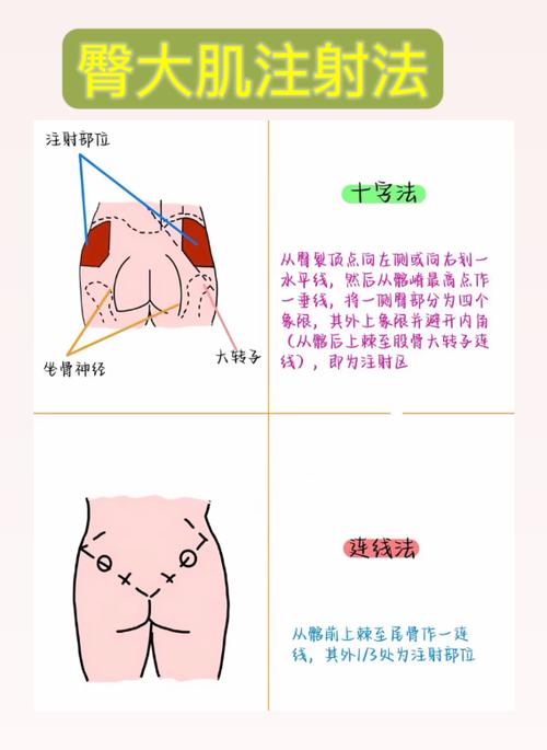 打屁股针的方法缩略图