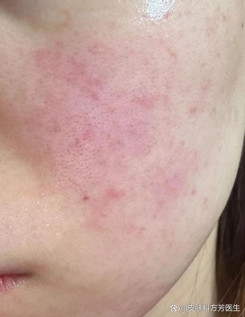 脸晒伤过敏发红痒怎么办缩略图