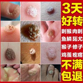 去肉粒最有效的药膏缩略图