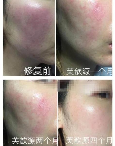 脸过敏缩略图
