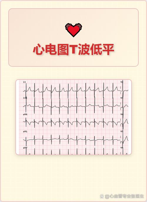 T波低平的临床意义缩略图
