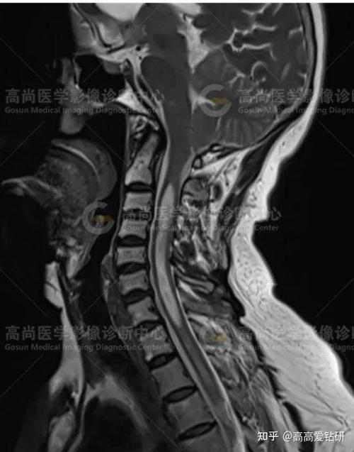 新手看颈椎MRI片图解缩略图