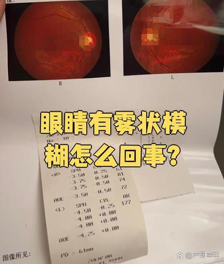 眼睛看着有雾是什么原因缩略图