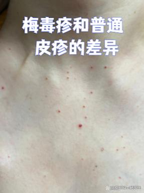 梅毒咨询医生免费咨询缩略图