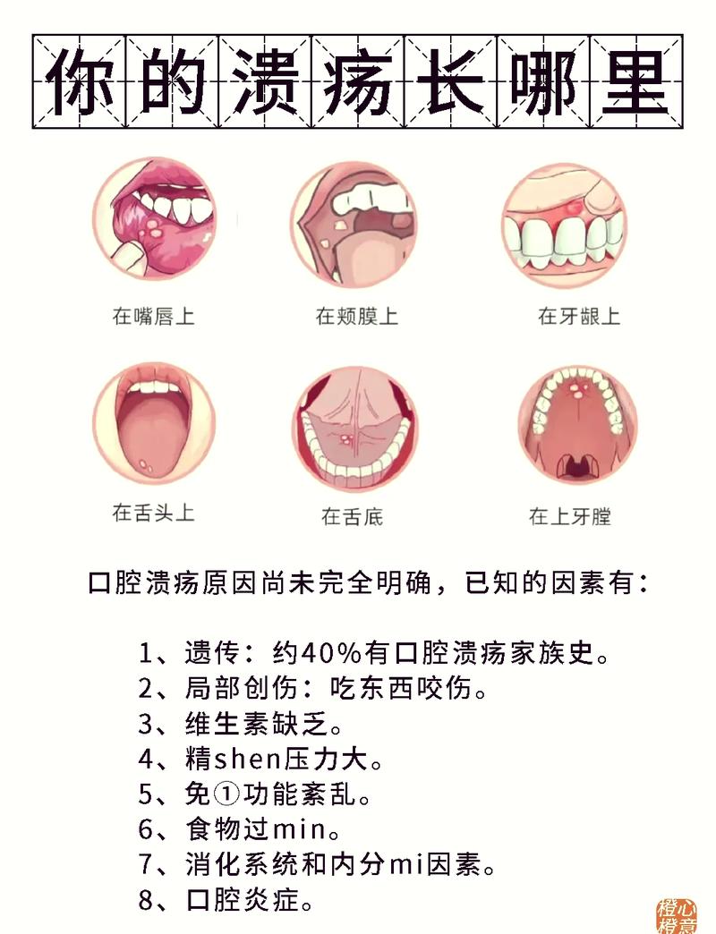 烂嘴的治疗方法缩略图