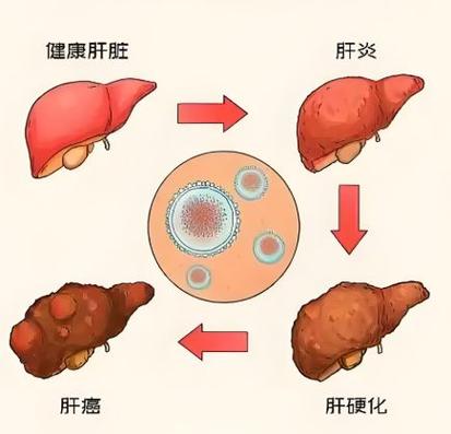 乙肝吃葡萄好不好缩略图