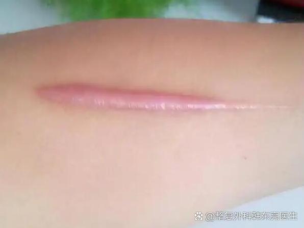 治疤痕最有效的药膏缩略图