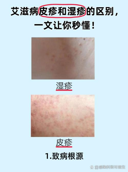 红疹和湿疹图片对照缩略图