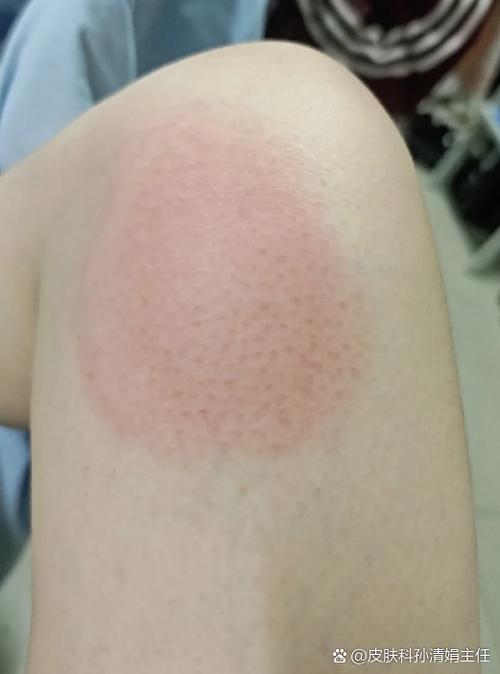 膏药过敏的症状游戏截图