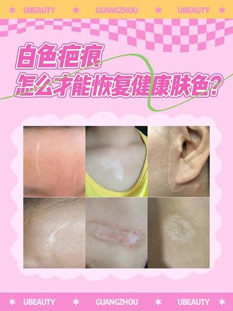 疤痕多久恢复正常肤色加速永久缩略图